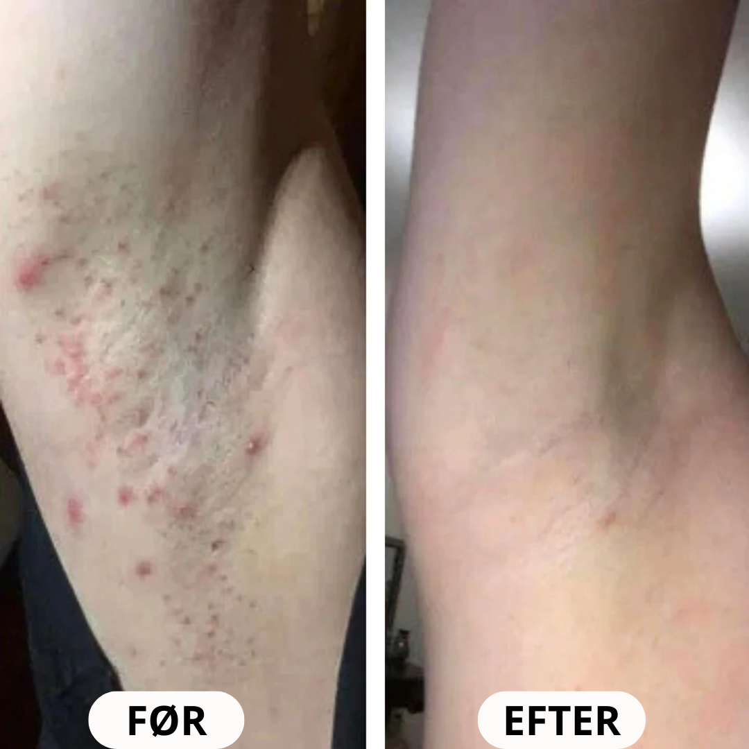 IPL Advanced+ hårfjerner - med HPLE teknologi og hele 17 J/cm² effekt - bedst i test
