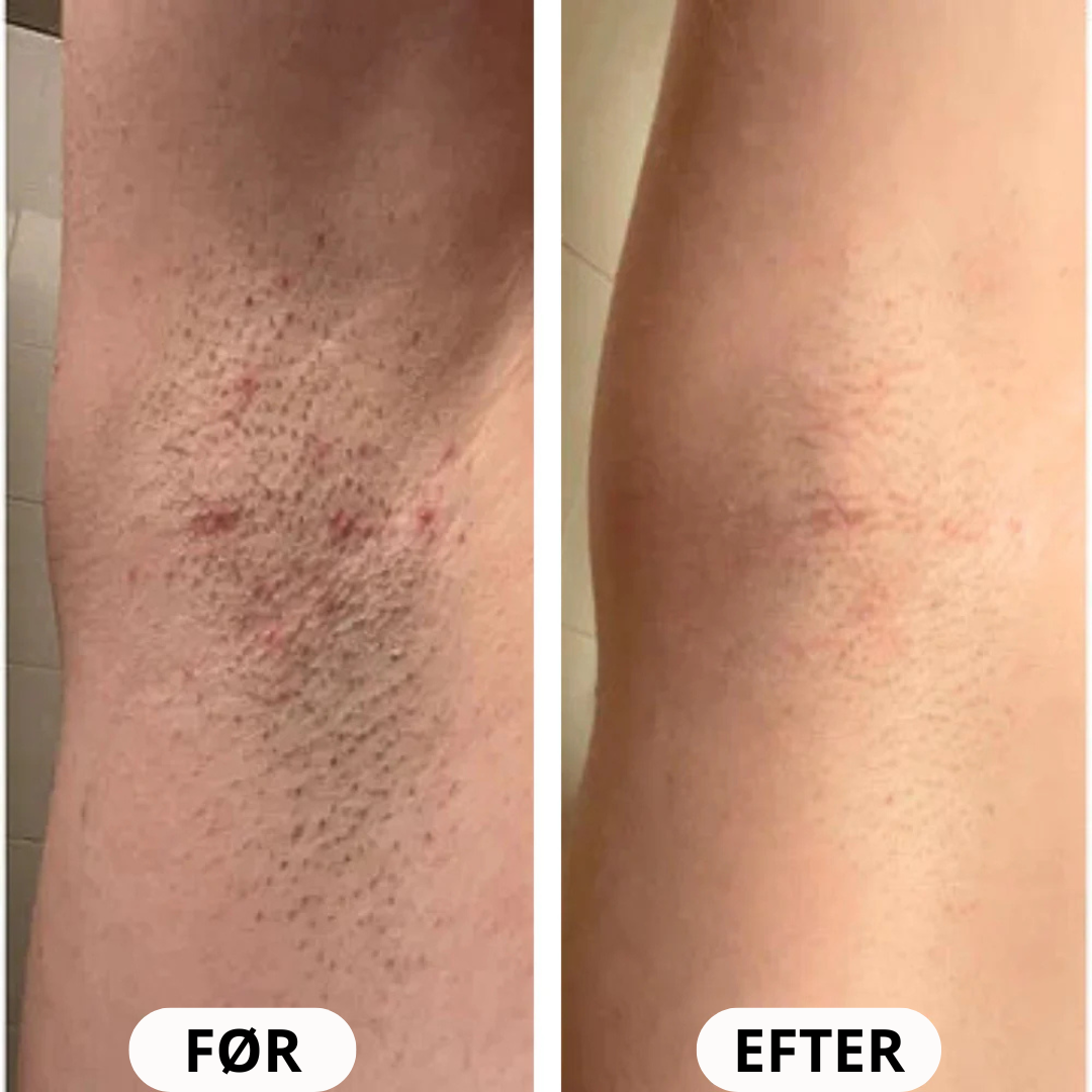 IPL Advanced+ hårfjerner - med HPLE teknologi og hele 17 J/cm² effekt - bedst i test